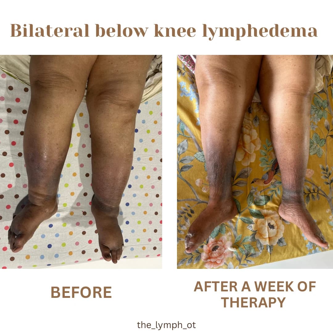 Bilateral below-knee therapy comparison before and after one week