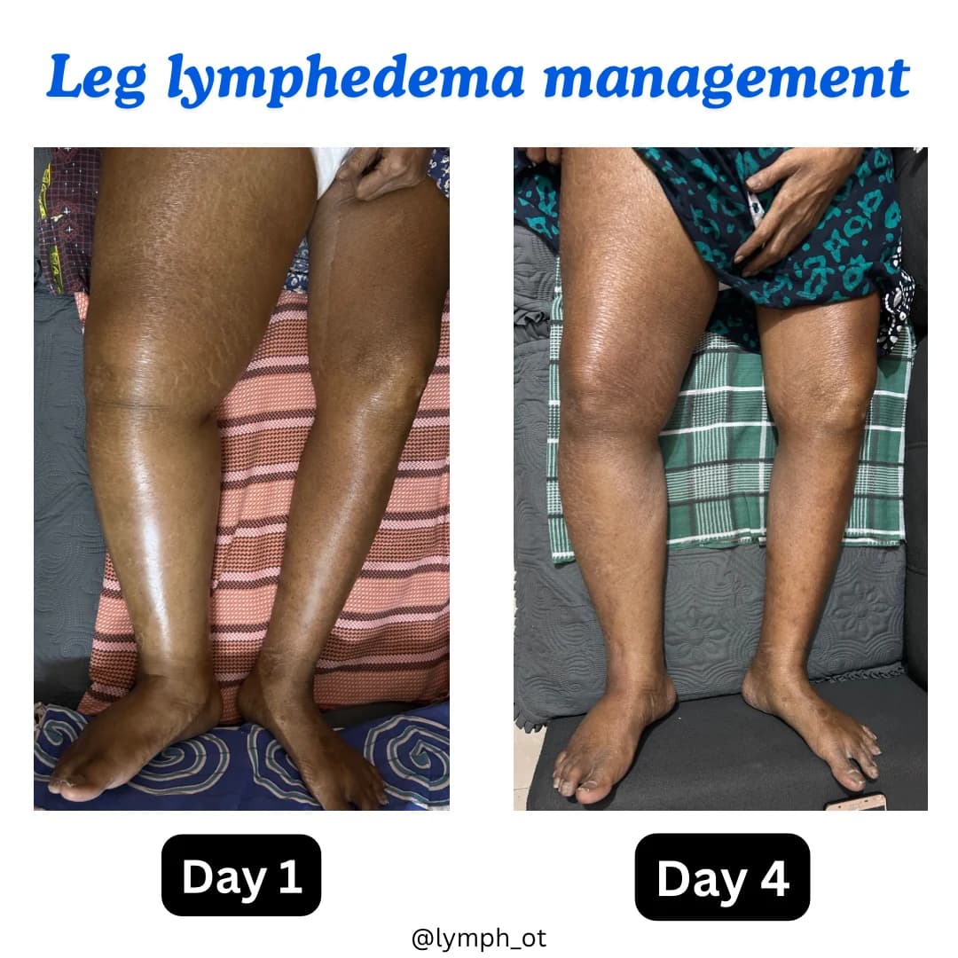 Lower-limb lymphedema management comparison showing Day 1 and Day 4