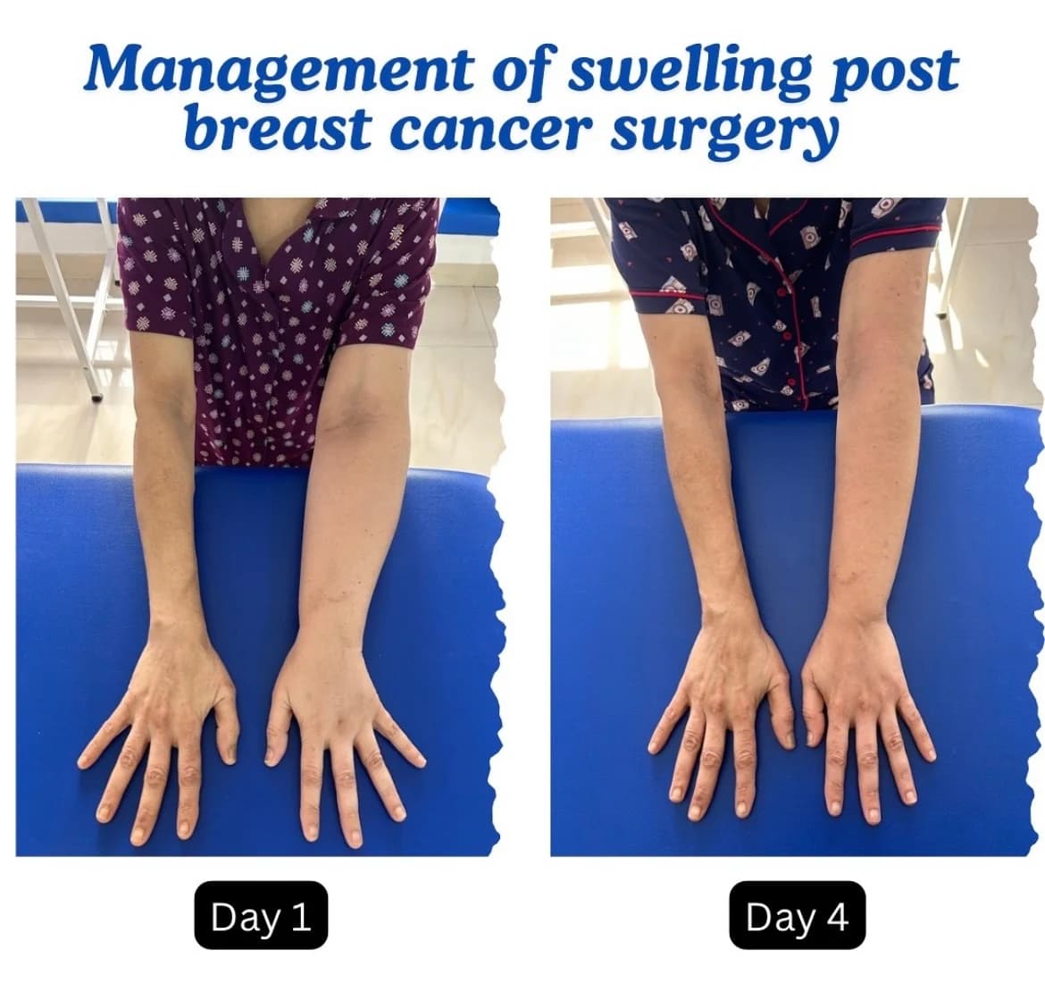 Post-breast-cancer arm swelling comparison showing Day 1 and Day 4