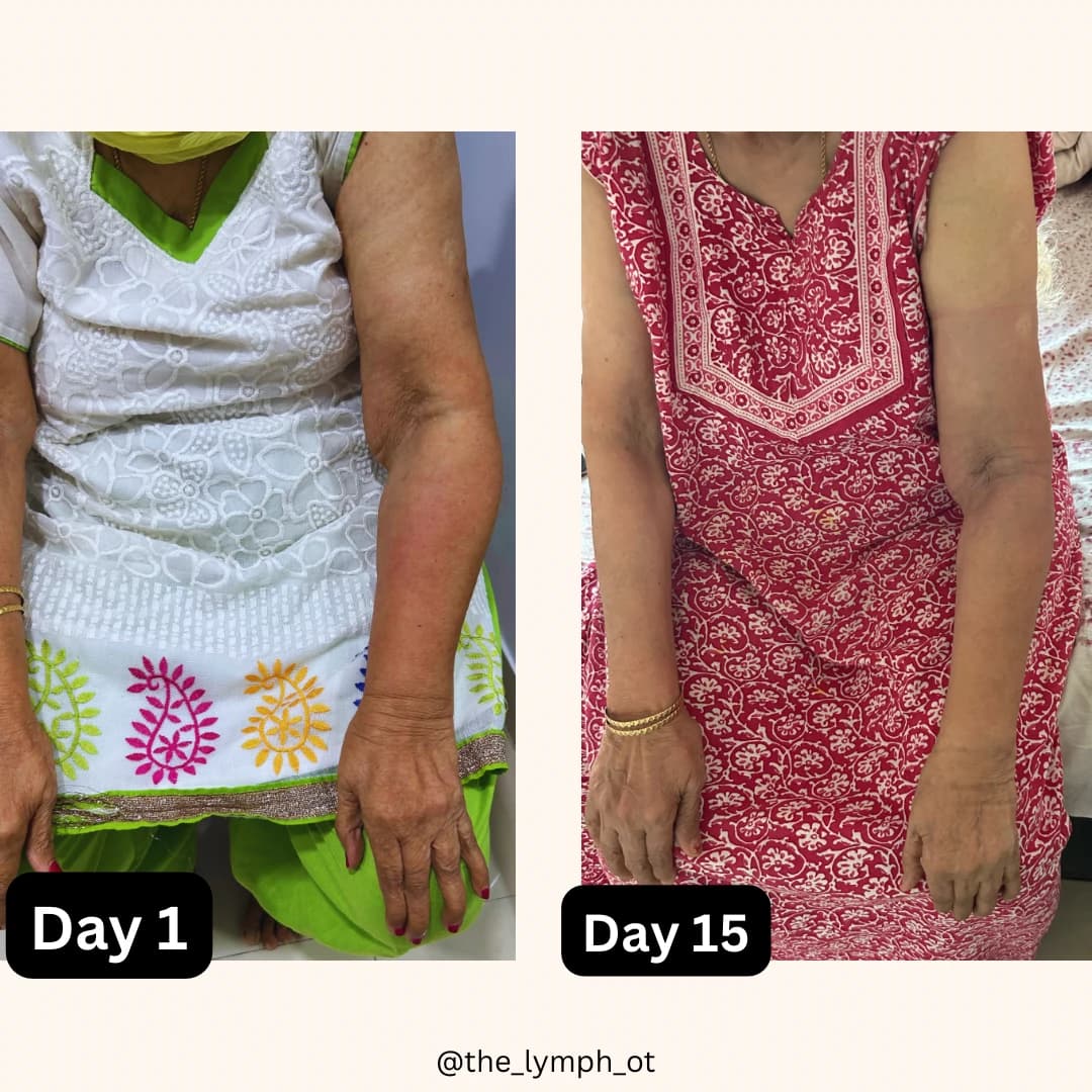 Upper-limb therapy comparison showing Day 1 and Day 15