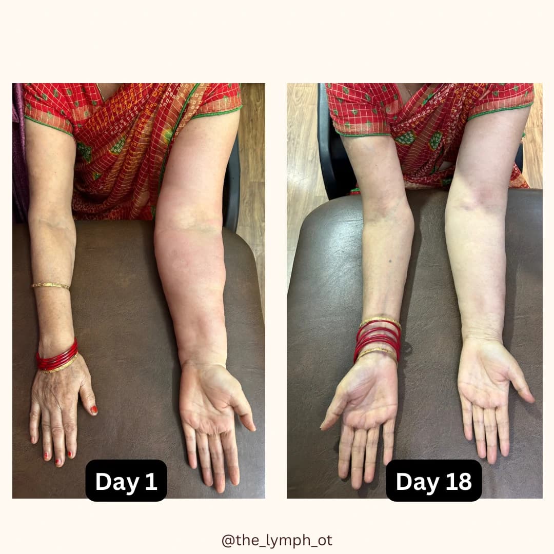 Upper-limb therapy comparison showing Day 1 and Day 18