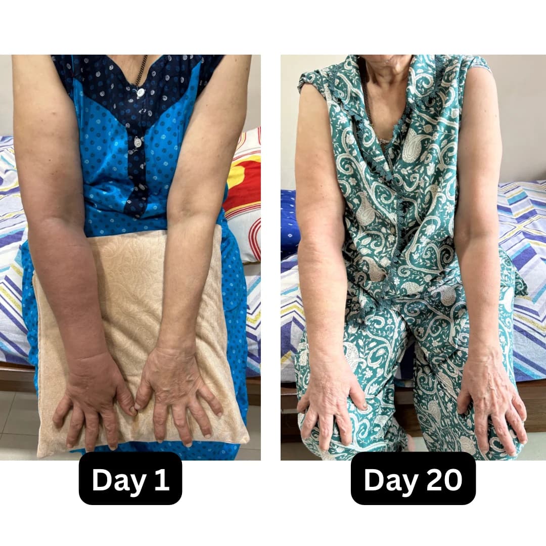 Upper-limb therapy comparison showing Day 1 and Day 20